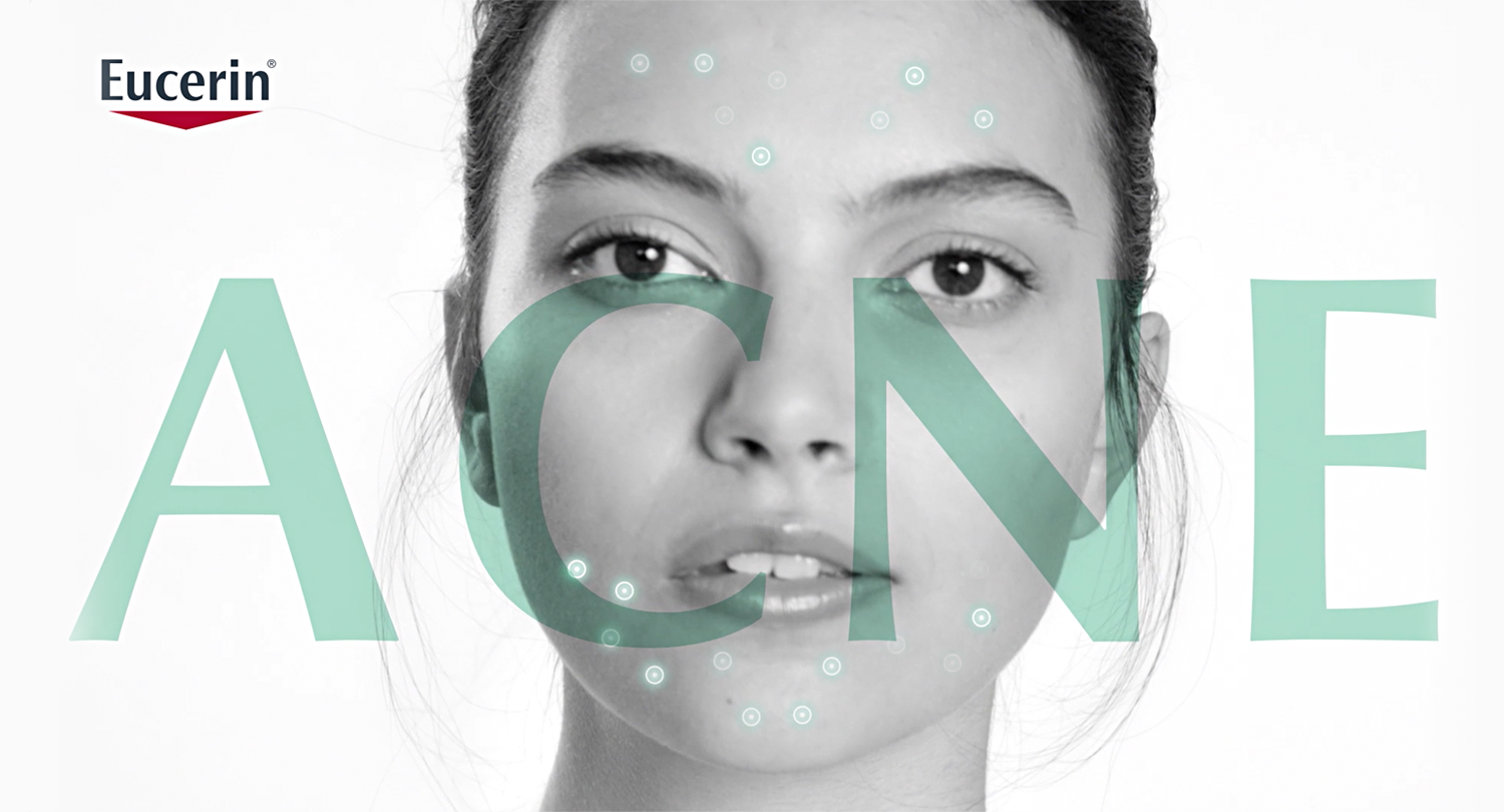 “I’M CONSTANTLY CHECKING MYSELF IN THE MIRROR. I ALWAYS WONDER, ARE OTHERS NOTICING MY PIMPLES AS MUCH AS I DO?”