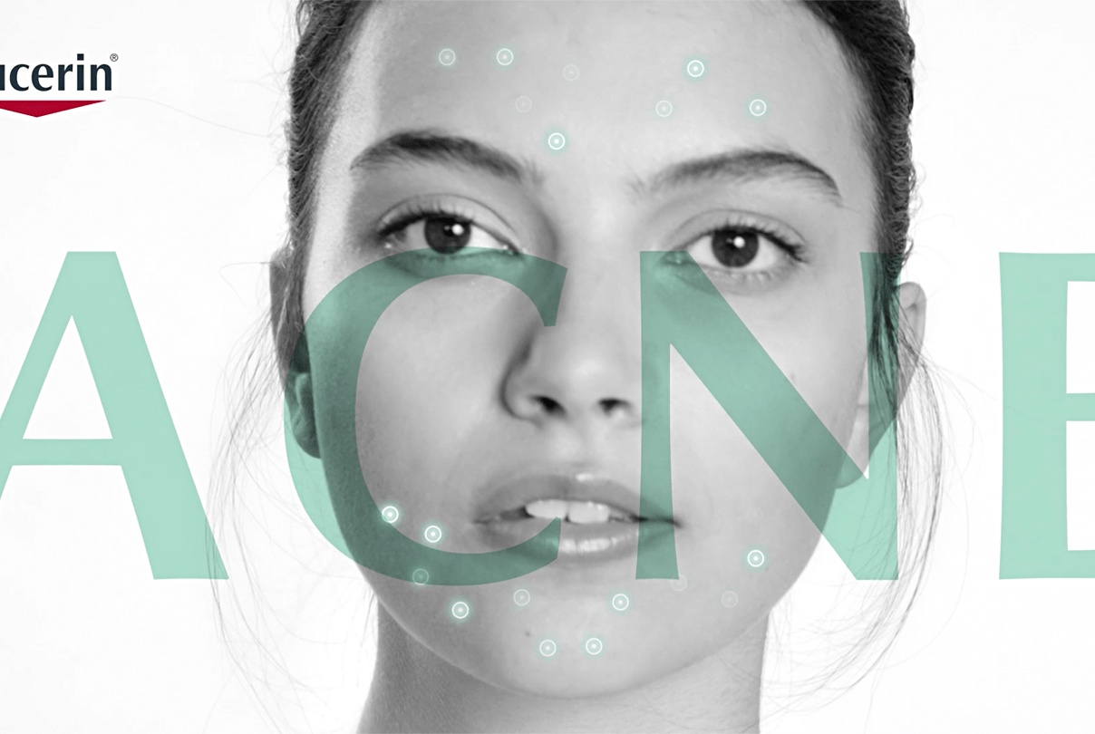 “I’M CONSTANTLY CHECKING MYSELF IN THE MIRROR. I ALWAYS WONDER, ARE OTHERS NOTICING MY PIMPLES AS MUCH AS I DO?”